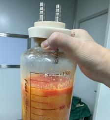永新水动力吸脂手术要做多久？